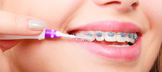 Learn About Your Braces